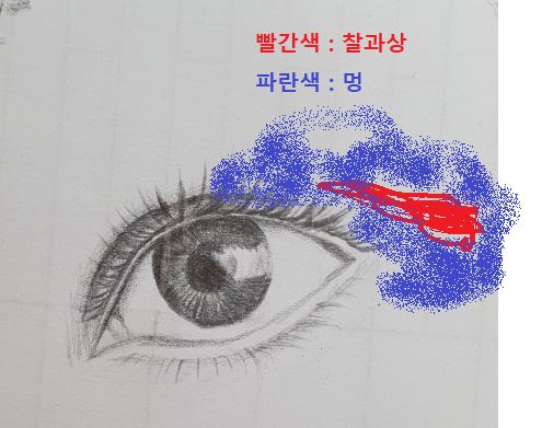 상처.JPG