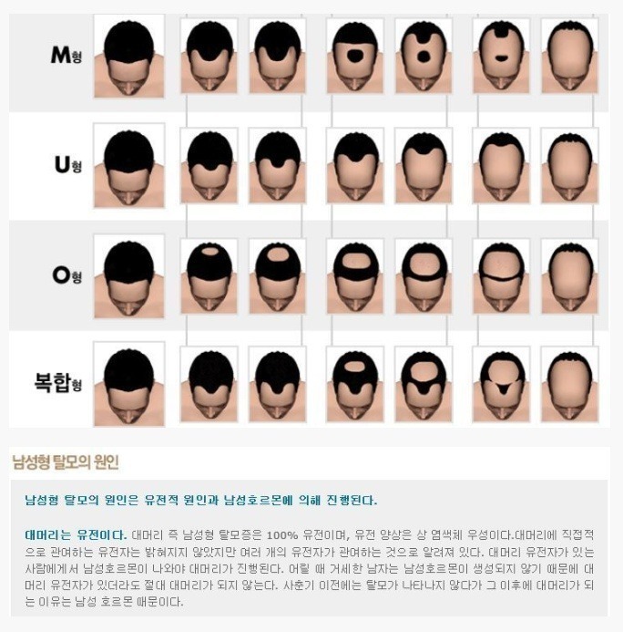 탈모는_유전.jpg