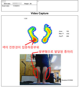 사진11 체험자의 체험전 양쪽발의 압력분포상태와 변형된 종아리근육.jpg