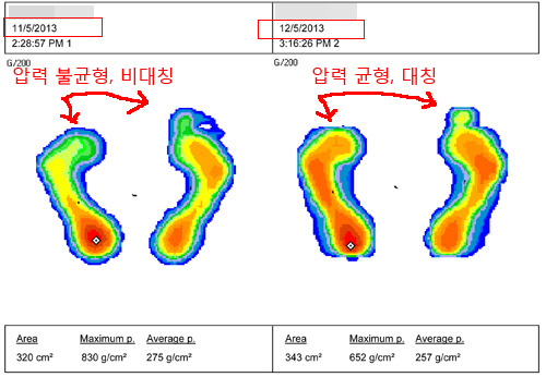 사진18 깔창착용전과 착용한달후 비교사진.jpg